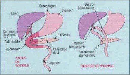 Grafico-Intervencion-Whipple.JPG