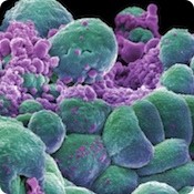 cancer1_cells.jpg